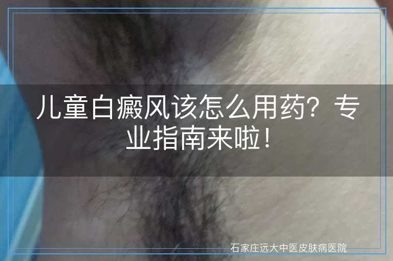 儿童白癜风该怎么用药？专业指南来啦！