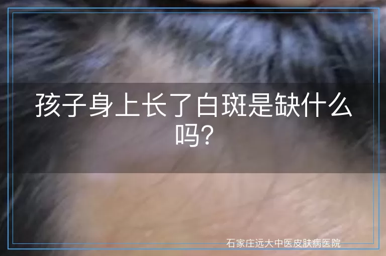孩子身上长了白斑是缺什么吗？
