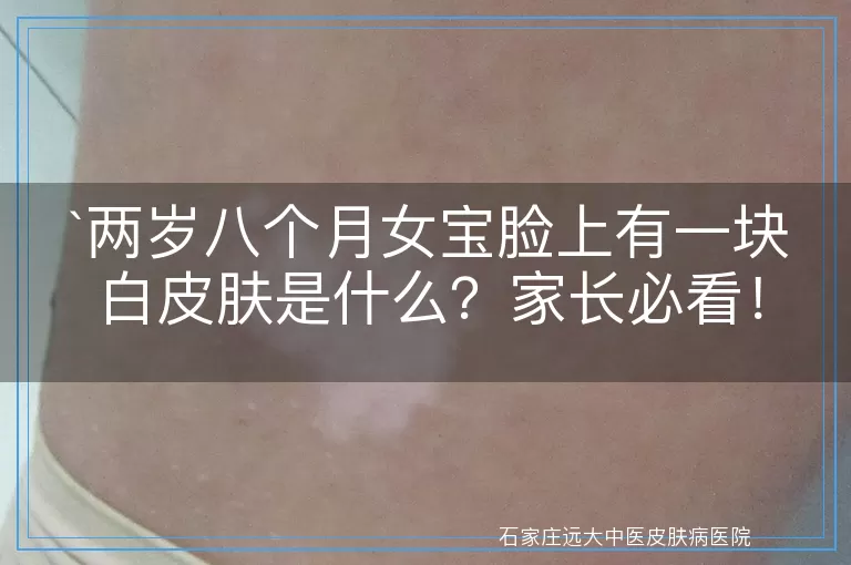 两岁八个月女宝脸上有一块白皮肤是什么？家长必看！