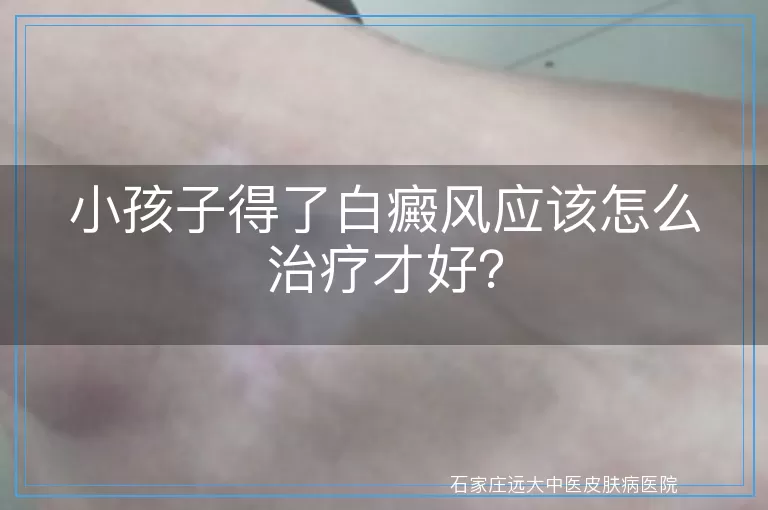 小孩子得了白癜风应该怎么治疗才好？