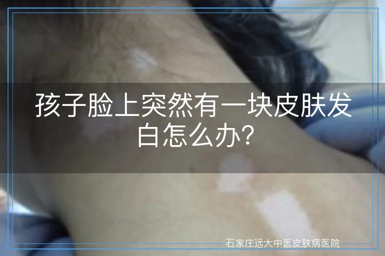 孩子脸上突然有一块皮肤发白怎么办？