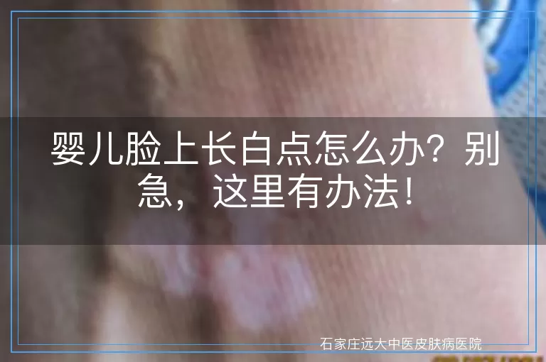 婴儿脸上长白点怎么办？别急，这里有办法！