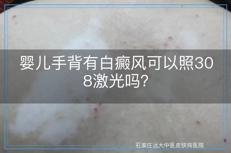婴儿手背有白癜风可以照308激光吗？