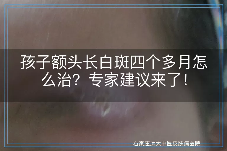 孩子额头长白斑四个多月怎么治？专家建议来了！