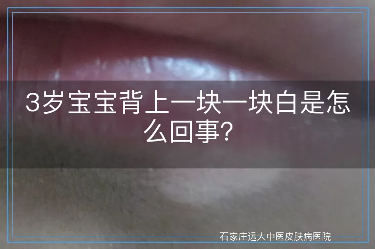 3岁宝宝背上一块一块白是怎么回事？