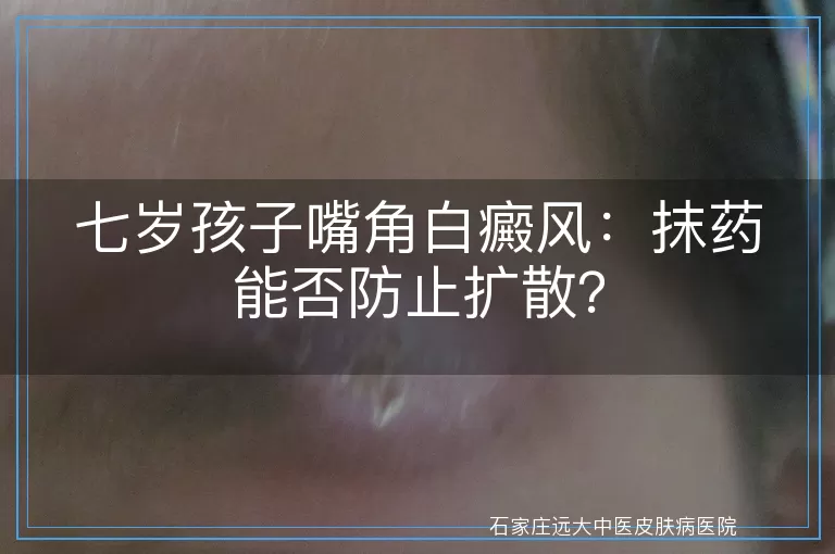 七岁孩子嘴角白癜风：抹药能否防止扩散？