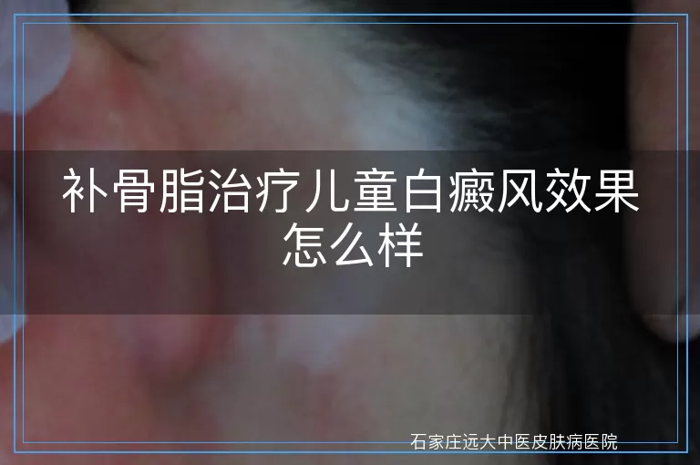 补骨脂治疗儿童白癜风效果怎么样