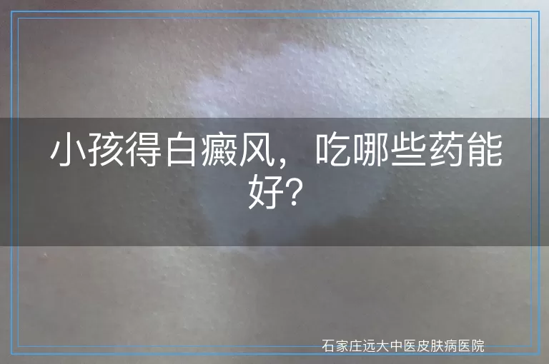 小孩得白癜风，吃哪些药能好？