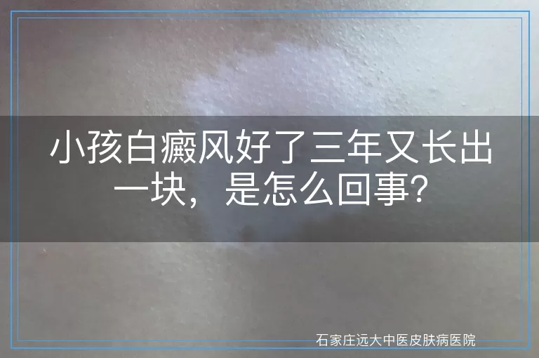 小孩白癜风好了三年又长出一块，是怎么回事？