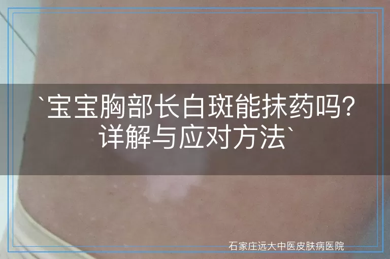 宝宝胸部长白斑能抹药吗？详解与应对方法