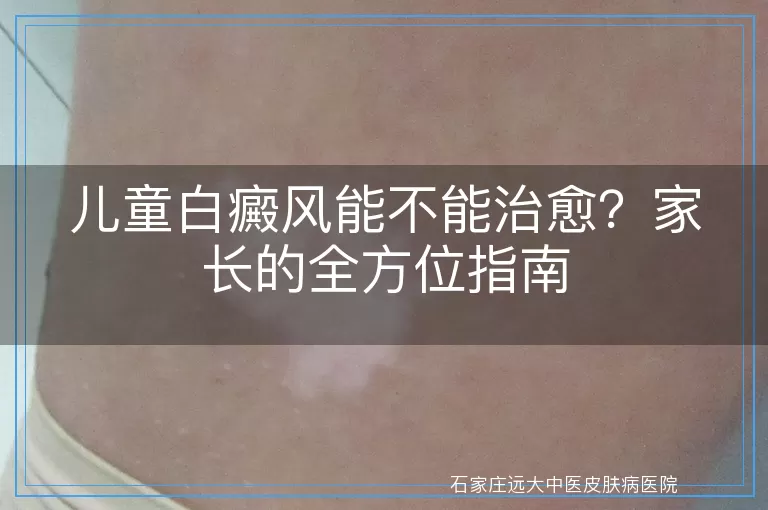 儿童白癜风能不能治愈？家长的全方位指南