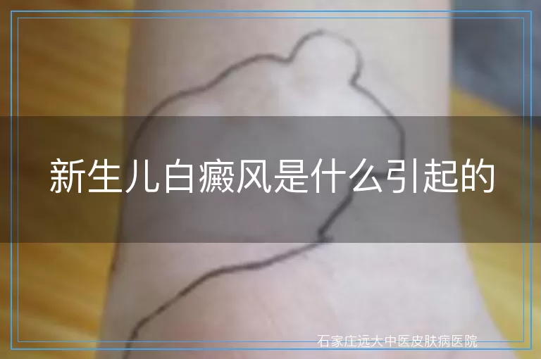 新生儿白癜风是什么引起的