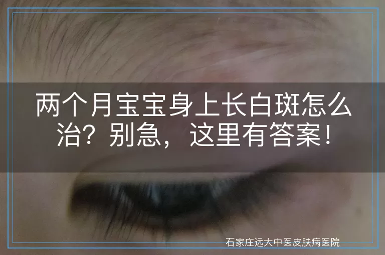 两个月宝宝身上长白斑怎么治？别急，这里有答案！