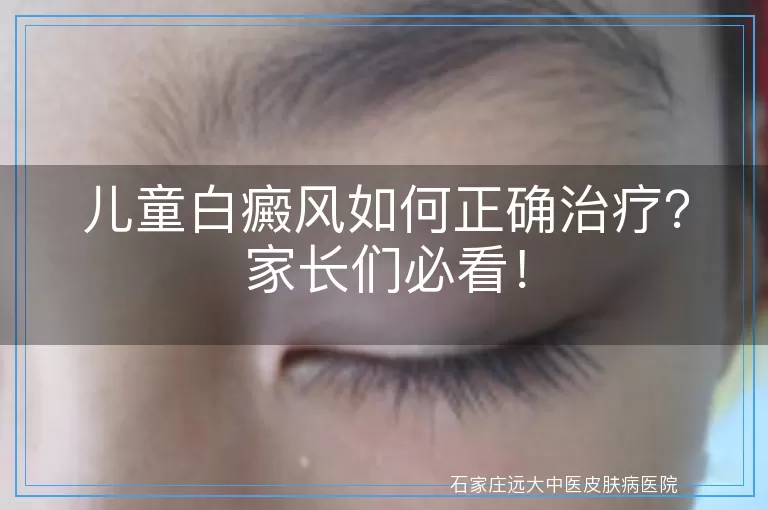 儿童白癜风如何正确治疗？家长们必看！