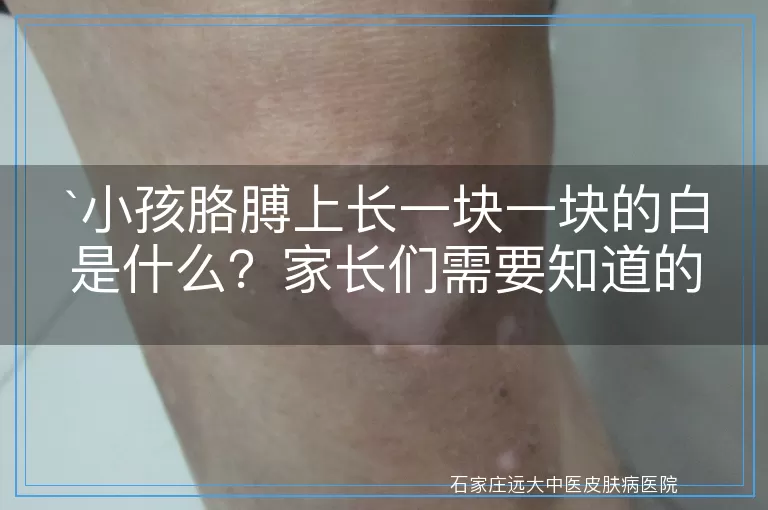 小孩胳膊上长一块一块的白是什么？家长们需要知道的真相！