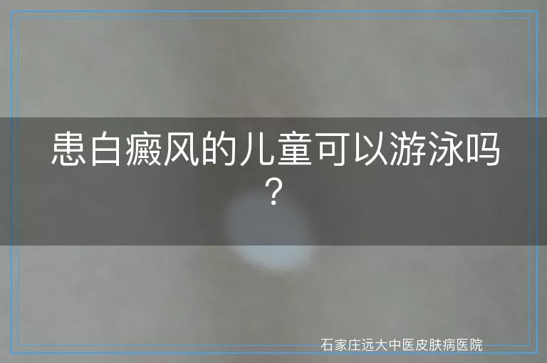 患白癜风的儿童可以游泳吗？