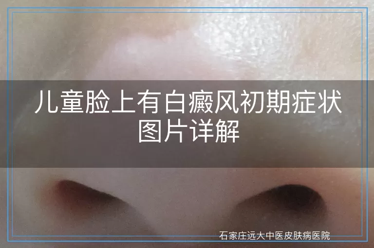 儿童脸上有白癜风初期症状图片详解