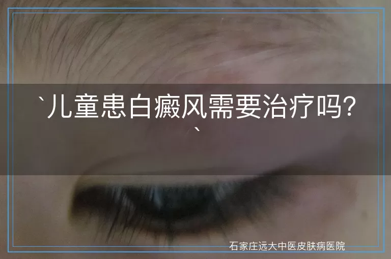 儿童患白癜风需要治疗吗?