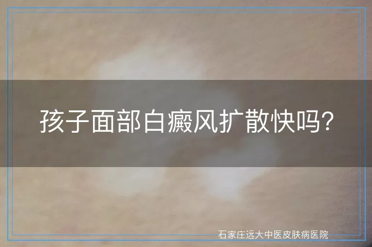 孩子面部白癜风扩散快吗？