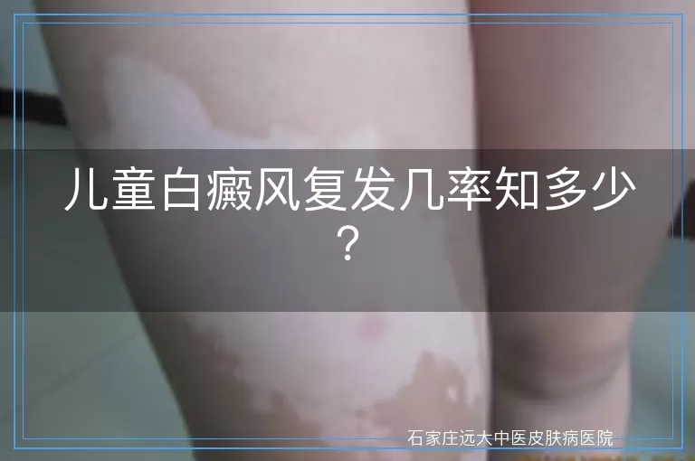 儿童白癜风复发几率知多少？
