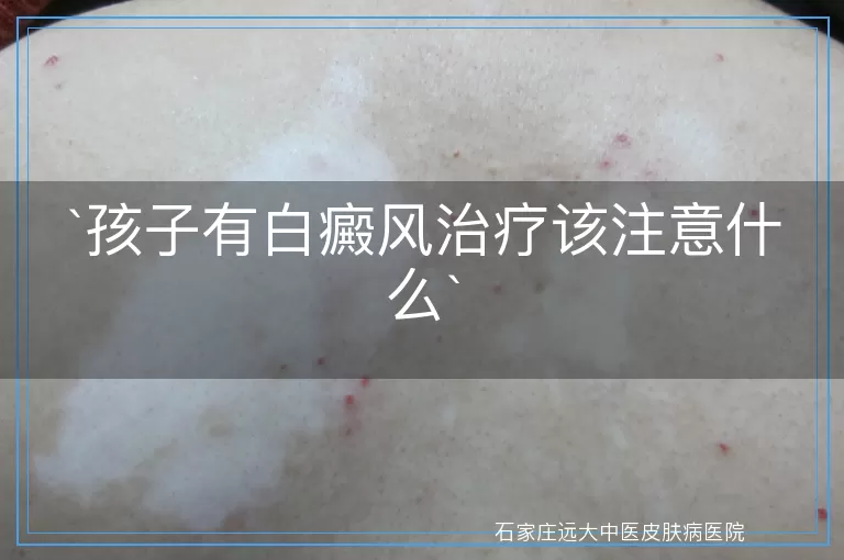 孩子有白癜风治疗该注意什么
