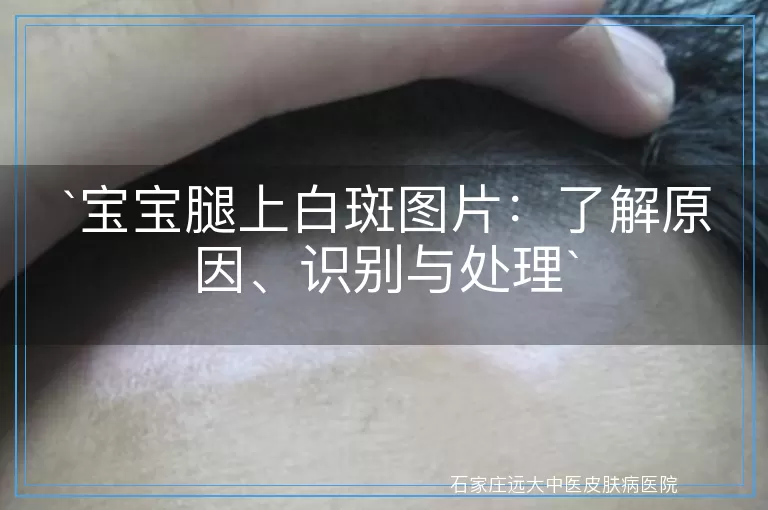宝宝腿上白斑图片：了解原因、识别与处理
