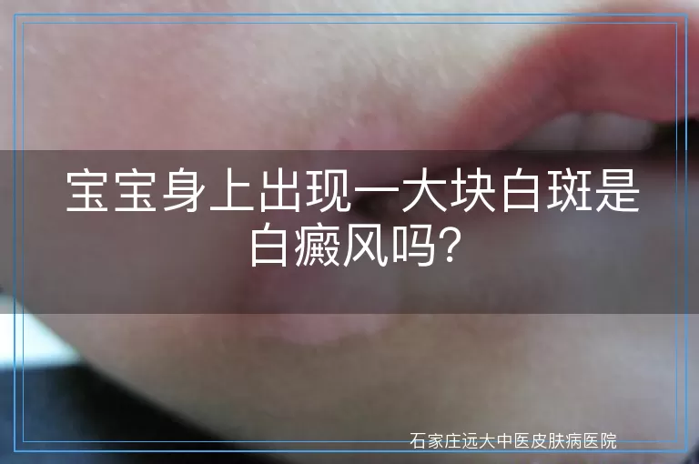 宝宝身上出现一大块白斑是白癜风吗？