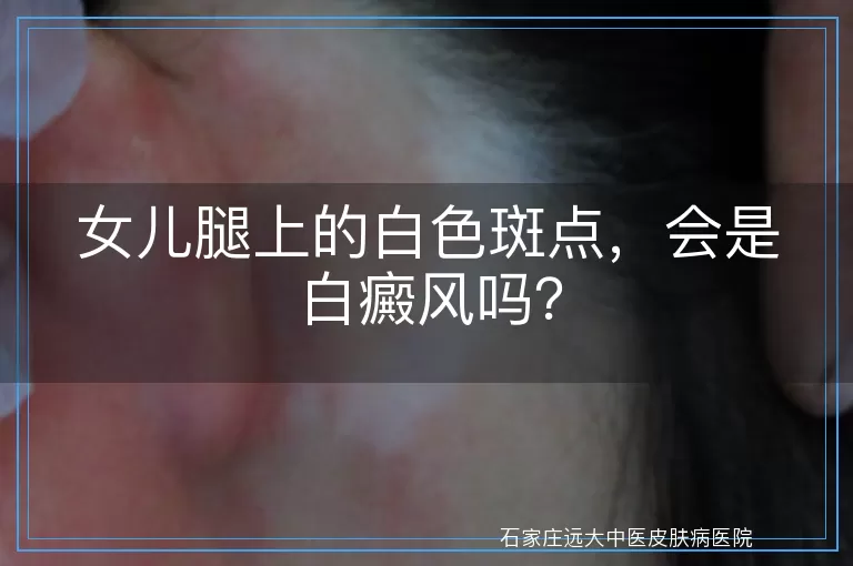 女儿腿上的白色斑点，会是白癜风吗？