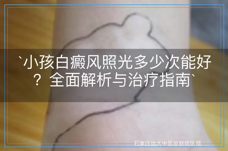 小孩白癜风照光多少次能好？全面解析与治疗指南