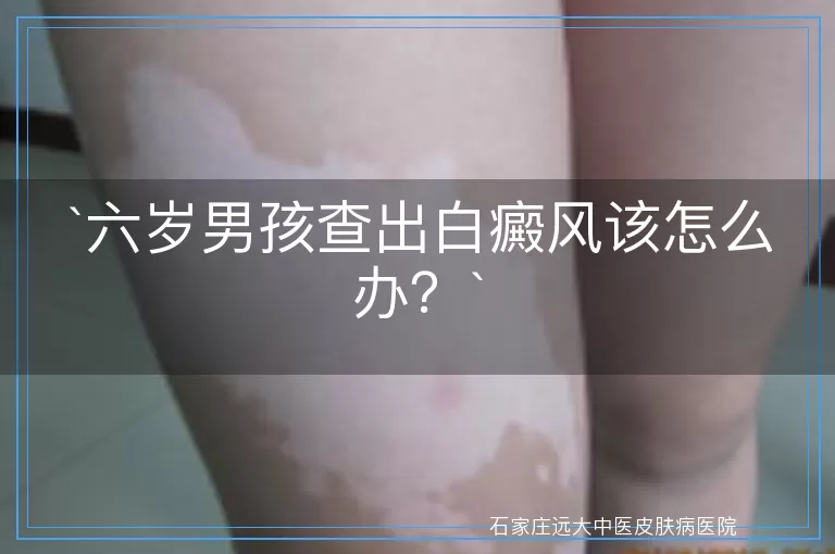 六岁男孩查出白癜风该怎么办？