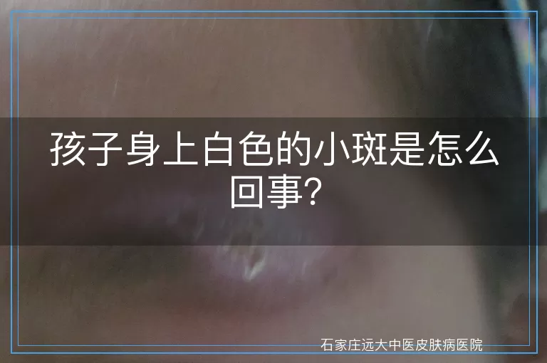 孩子身上白色的小斑是怎么回事？
