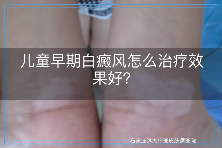 儿童早期白癜风怎么治疗效果好？