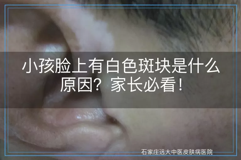 小孩脸上有白色斑块是什么原因？家长必看！