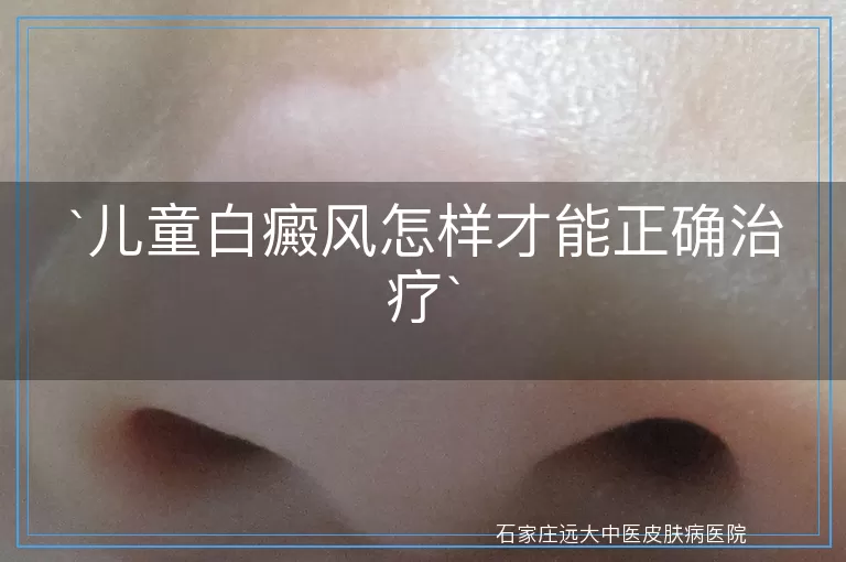 儿童白癜风怎样才能正确治疗