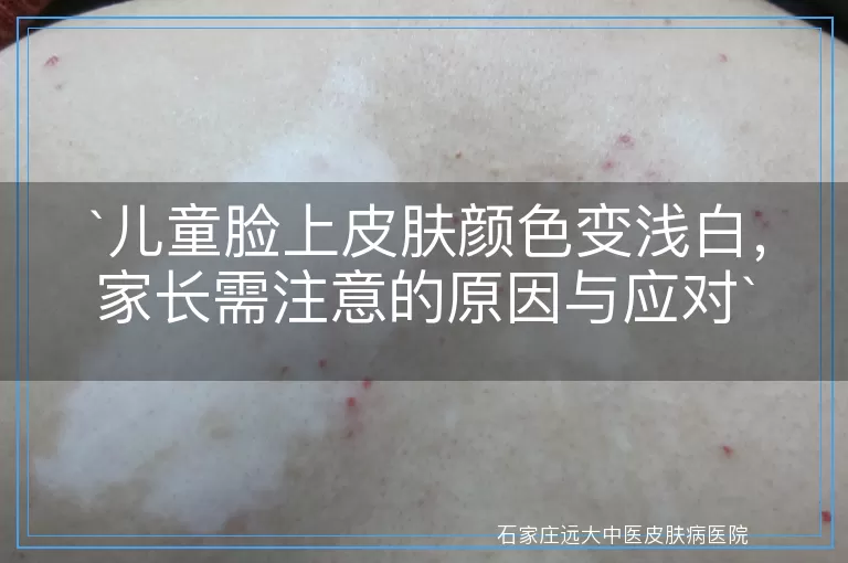 儿童脸上皮肤颜色变浅白,家长需注意的原因与应对