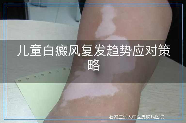 儿童白癜风复发趋势应对策略