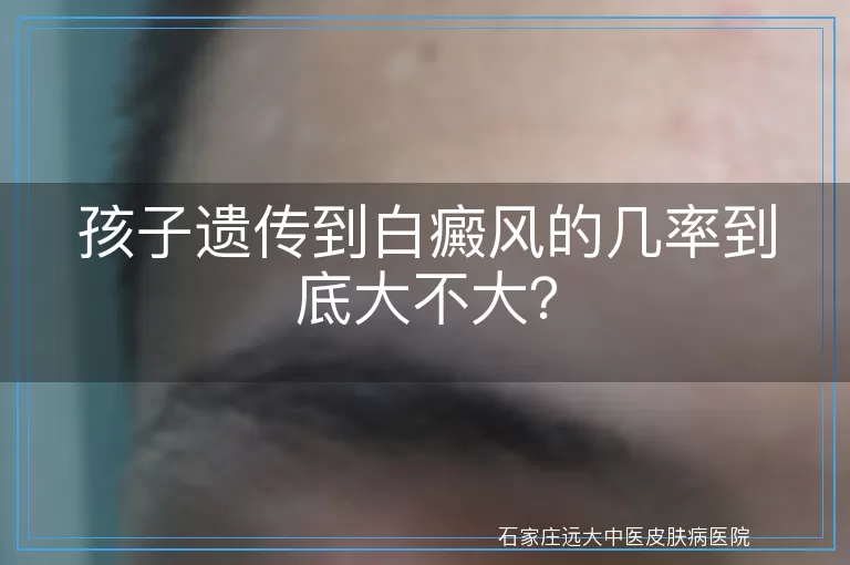 孩子遗传到白癜风的几率到底大不大？