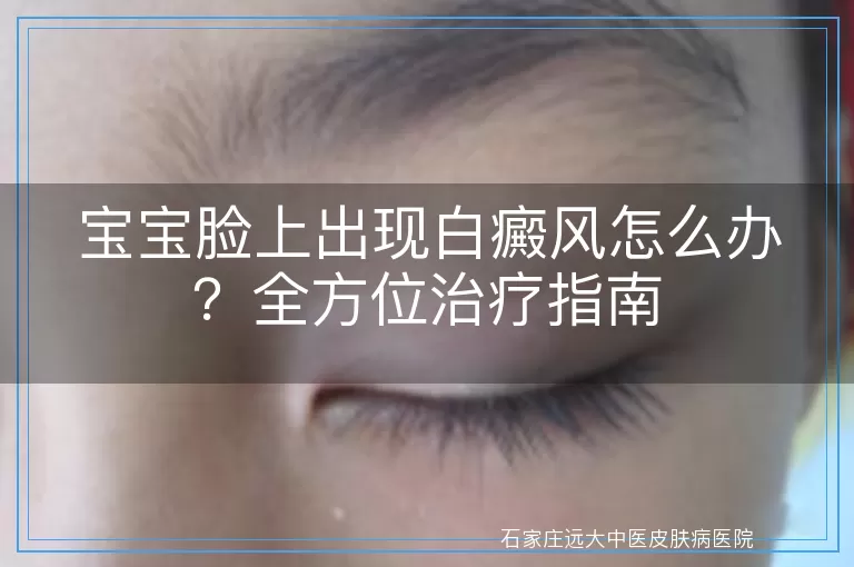 宝宝脸上出现白癜风怎么办?全方位治疗指南