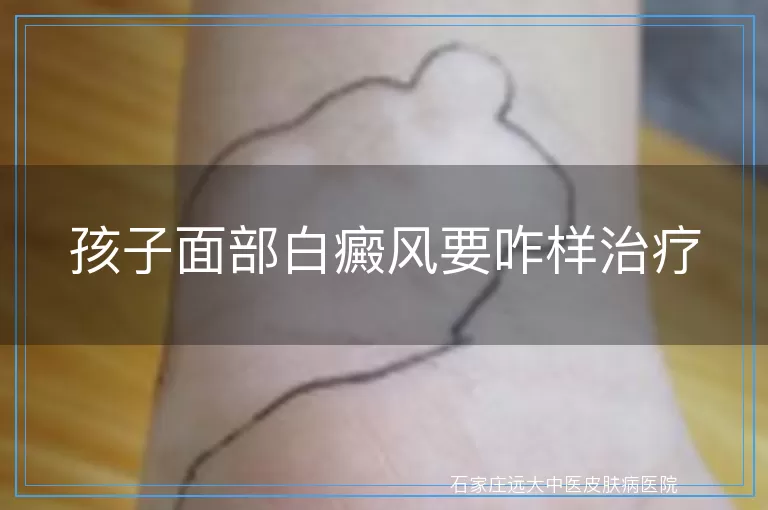 孩子面部白癜风要咋样治疗
