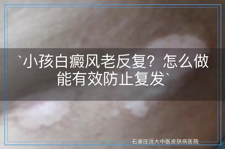 小孩白癜风老反复？怎么做能有效防止复发