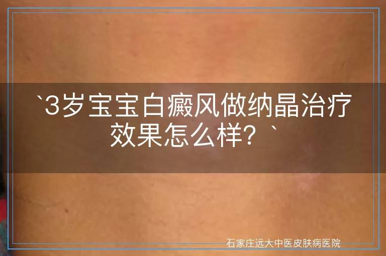 3岁宝宝白癜风做纳晶治疗效果怎么样？