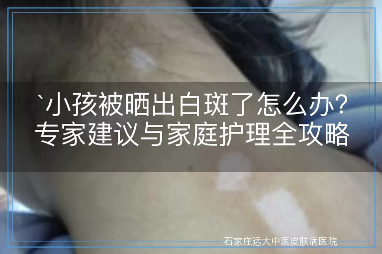 小孩被晒出白斑了怎么办？专家建议与家庭护理全攻略