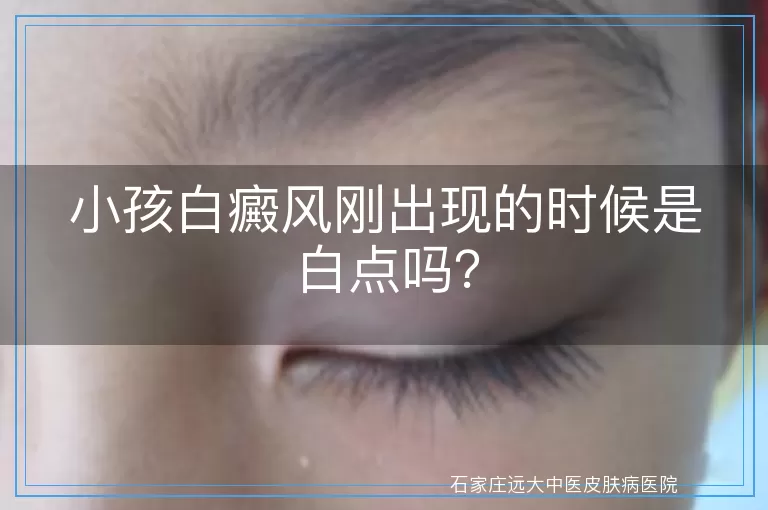 小孩白癜风刚出现的时候是白点吗？