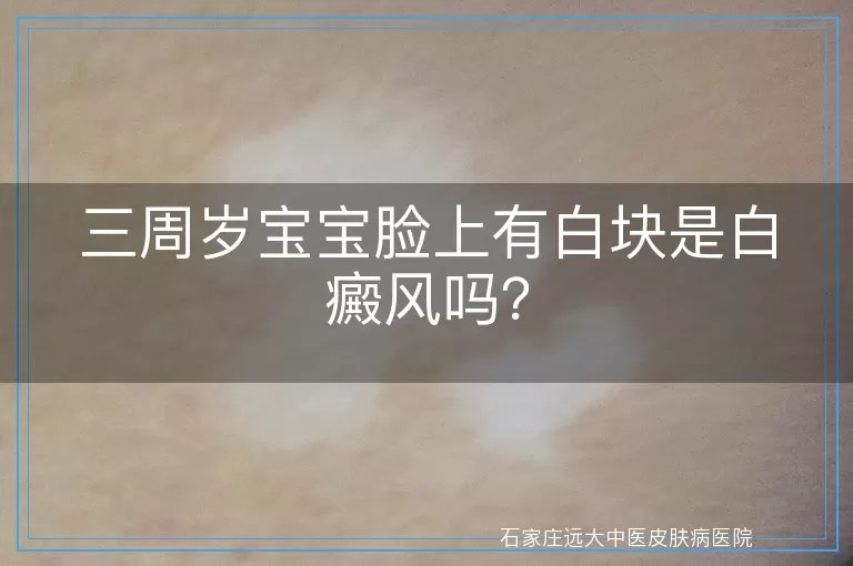 三周岁宝宝脸上有白块是白癜风吗？
