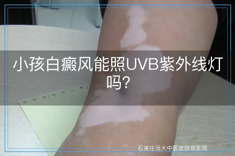 小孩白癜风能照UVB紫外线灯吗？