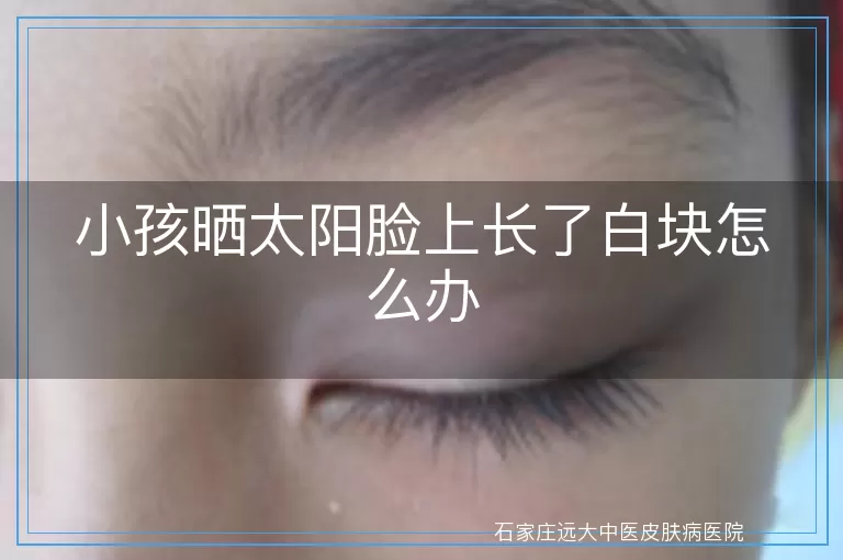 小孩晒太阳脸上长了白块怎么办