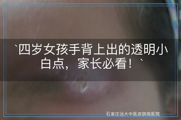四岁女孩手背上出的透明小白点，家长必看！