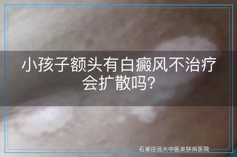 小孩子额头有白癜风不治疗会扩散吗？