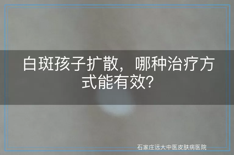 白斑孩子扩散，哪种治疗方式能有效？