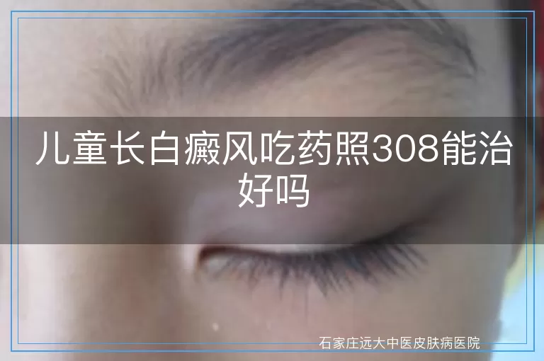 儿童长白癜风吃药照308能治好吗